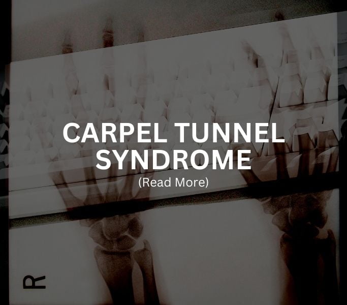 CARPEL TUNNEL SYNDROME Treatment at Arthritis Clinic of Cypress and Katy