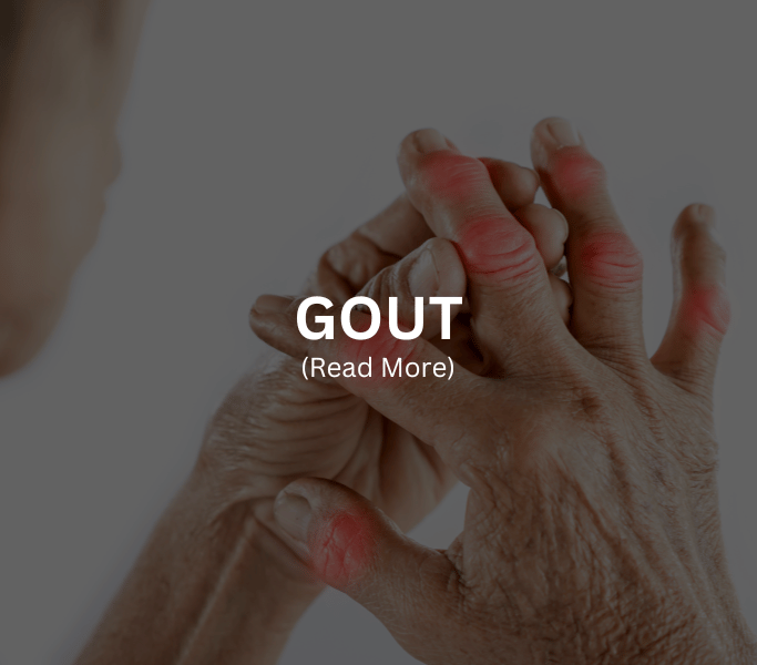 Gout Treatment at Arthritis Clinic of Cypress and Katy