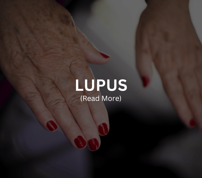 lupus Treatment at Arthritis Clinic of Cypress and Katy