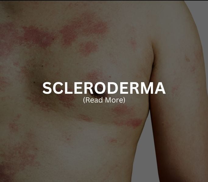 SCLERODERMA Treatment at Arthritis Clinic of Cypress and Katy