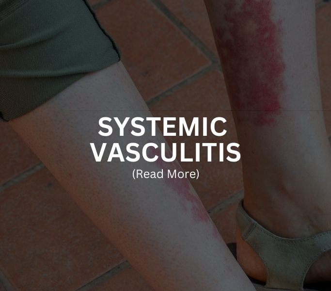SYSTEMIC VASCULITIS Treatment at Arthritis Clinic of Cypress and Katy