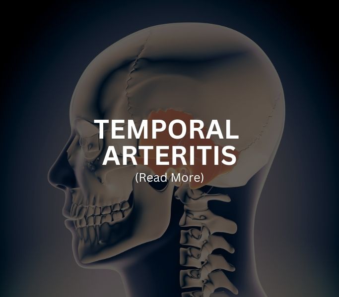 TEMPORAL ARTERITIS Treatment at Arthritis Clinic of Cypress and Katy