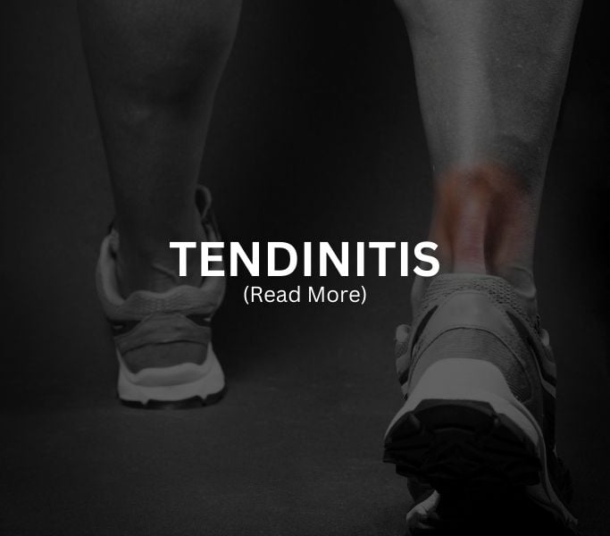TENDINITIS Treatment at Arthritis Clinic of Cypress and Katy